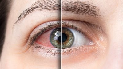أعراض جفاف العين وطريقة وحيدة لحماية القرنية