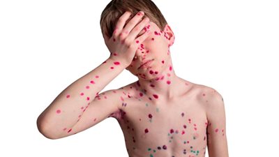 بعد تفشي جدري القرود.. إجراءات طارئة في الصين لاحتواء الفيروس