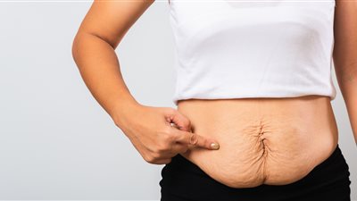 4 خطوات سهلة تخلصك من ترهلات البطن بعد الولادة القيصرية 