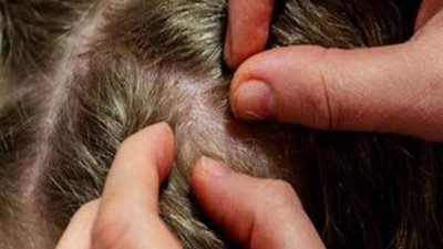 3 طرق طبيعية للتخلص من القمل