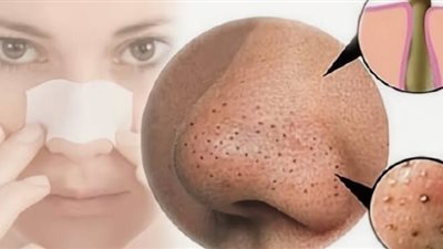 كيف استخدم معجون الأسنان لإزالة الرؤوس السوادء؟ 4 خطوات