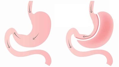 كيف اعرف أن عملية تكميم المعدة ناجحة؟