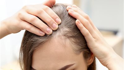 3 أسباب لتساقط الشعر من الأمام وطرق العلاج
