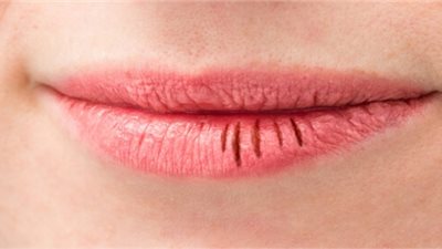 5 نصائح تخلصك من تشقق الشفاه في الشتاء