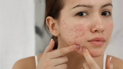 4 أطعمة تسبب ظهور حب الشباب 