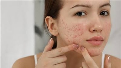 4 أطعمة تسبب ظهور حب الشباب (إنفوجراف)