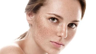 وصفات طبيعية فعالة لعلاج الكلف في المنزل