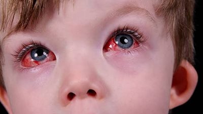 3 طرق لعلاج إحمرار العين عند الأطفال 