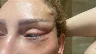 3 أضرار لعمليات التجميل بعد تشوه وجه ريهام سعيد