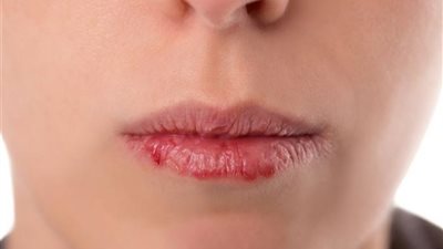 5 نصائح لتجنب جفاف الشفاه في رمضان 2024