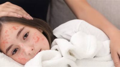 الصحة تطلق حملة تطعيم موسعة للأطفال ضد الحصبة والحصبة الألمانية