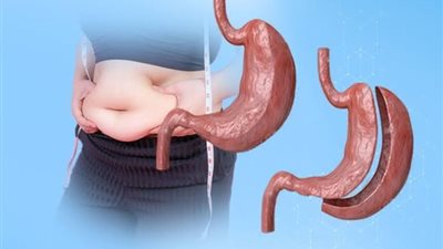 5 أعراض جانبية بعد إجراء تكميم المعدة.. اكتشفيها 