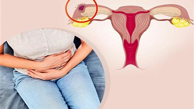 5 عوامل تؤدي لحدوث الحمل خارج الرحم