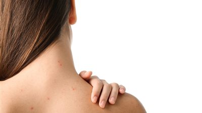 خلطات طبيعية فعالة لعلاج حب الشباب في الظهر